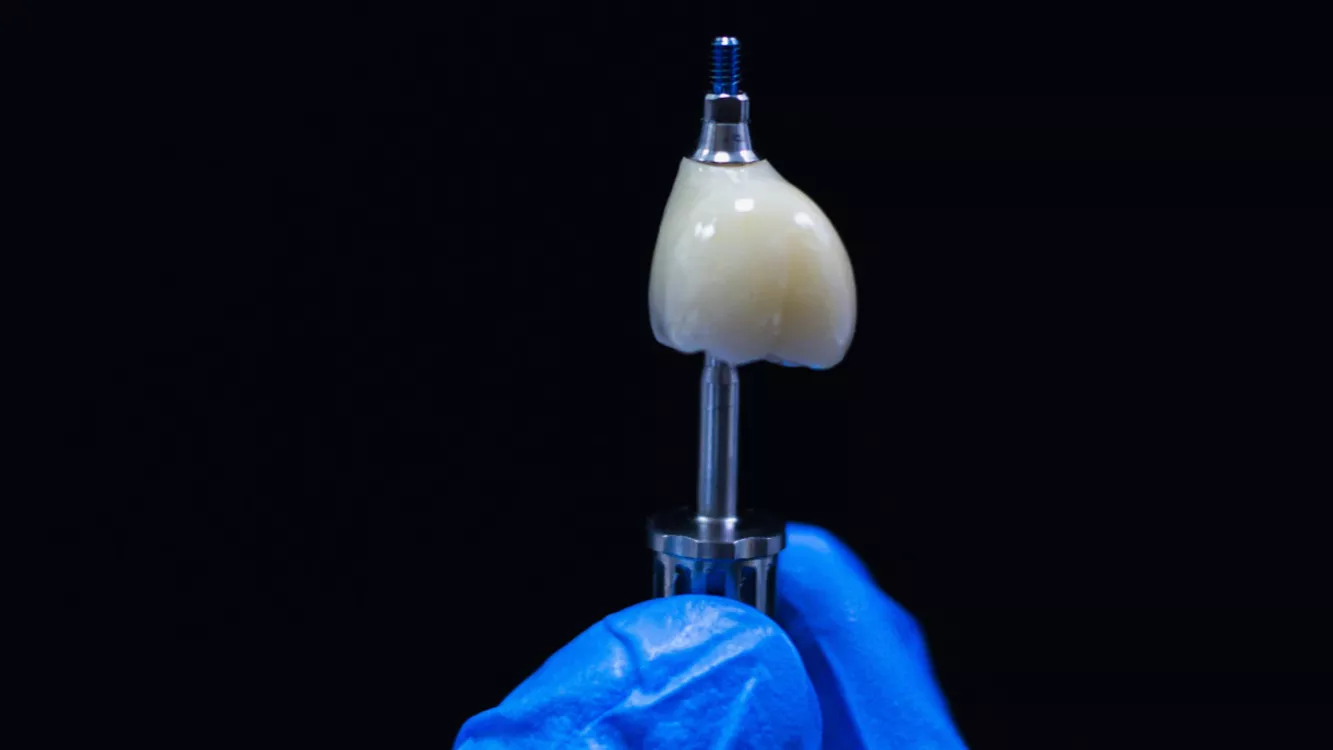 Close-up of an immediate implant placement.