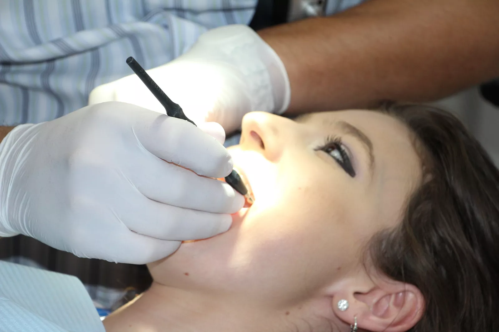 An immediate implant placement procedure.
