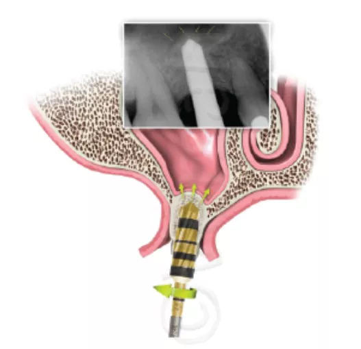 Sample illustration of a crestal sinus lift procedure.