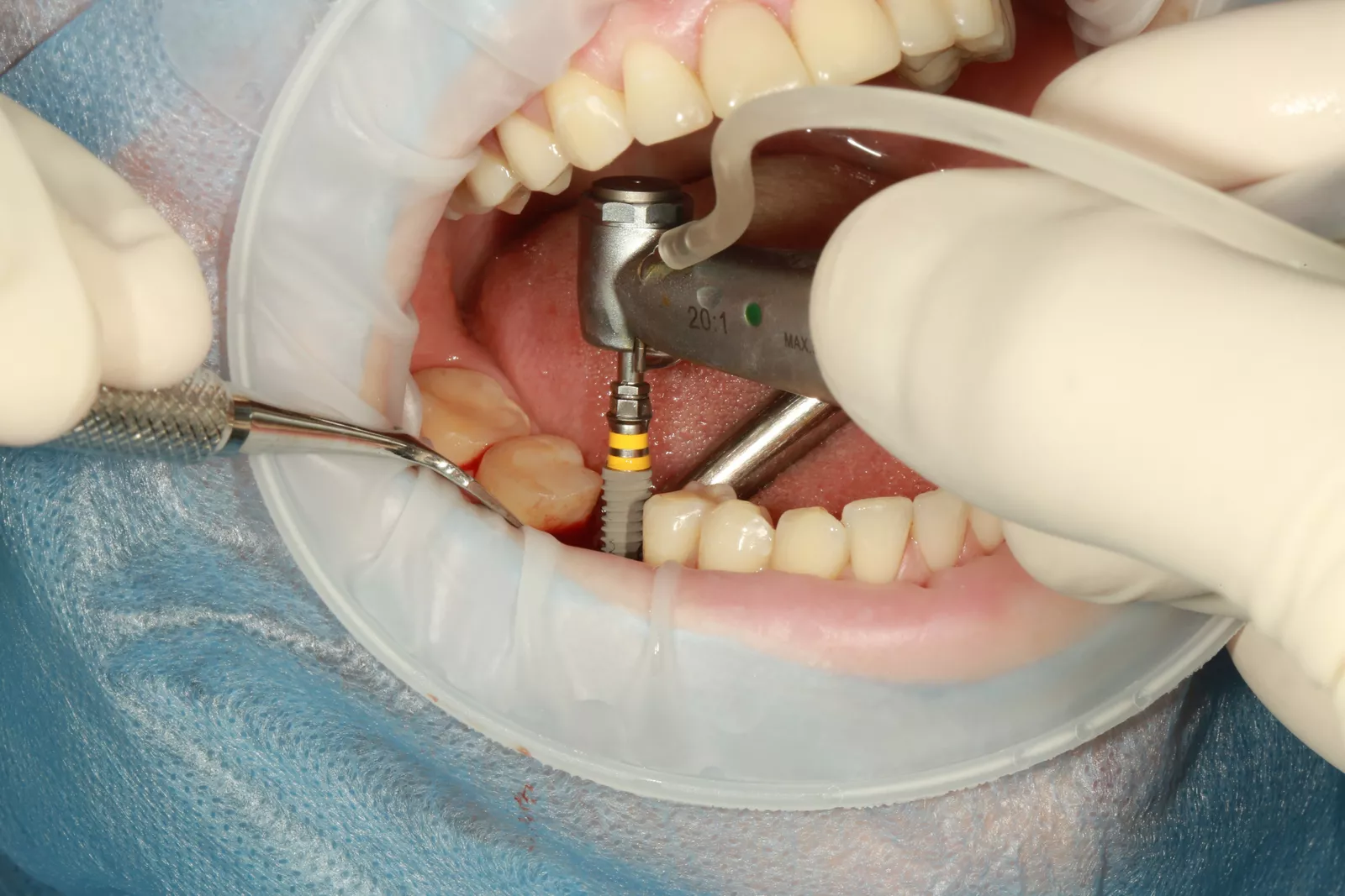 Close-up of a dental implant procedure.